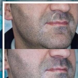 تتو بدن، میکرو بلیدینگ