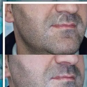 تتو بدن، میکرو بلیدینگ