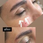 مزو ژل بوتاکس آنزیم پیرسینگ ( ملکی)