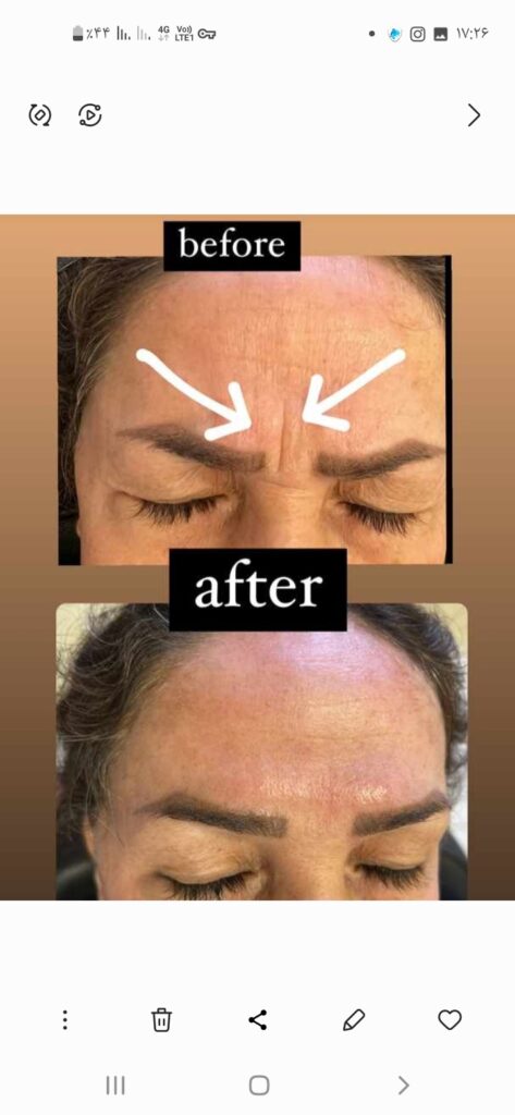 مزو ژل بوتاکس آنزیم پیرسینگ ( ملکی)