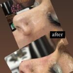 مزو ژل بوتاکس آنزیم پیرسینگ ( ملکی)
