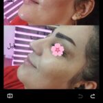 مزو ژل بوتاکس آنزیم پیرسینگ ( ملکی)
