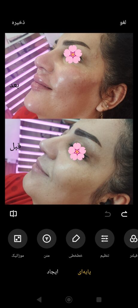 مزو ژل بوتاکس آنزیم پیرسینگ ( ملکی)