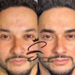 تتو بدن، میکرو بلیدینگ