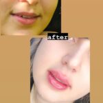 مزو ژل بوتاکس آنزیم پیرسینگ ( ملکی)