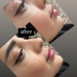 مزو ژل بوتاکس آنزیم پیرسینگ ( ملکی)