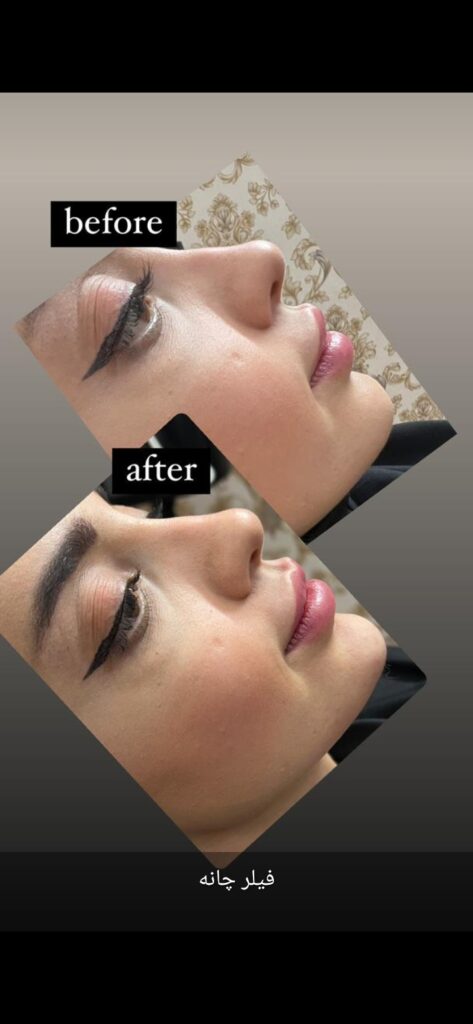 مزو ژل بوتاکس آنزیم پیرسینگ ( ملکی)