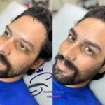 تتو بدن، میکرو بلیدینگ
