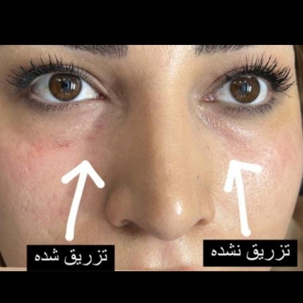 مزو ژل بوتاکس آنزیم پیرسینگ ( ملکی)