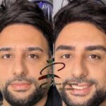 تتو بدن، میکرو بلیدینگ