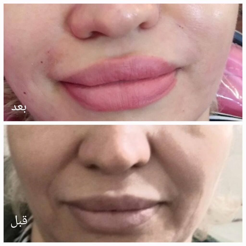 مزو ژل بوتاکس آنزیم پیرسینگ ( ملکی)