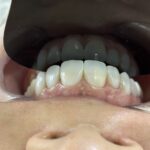 دندانپزشکی زیبایی دکتر طاهریا/ جشنواره کامپوزیت