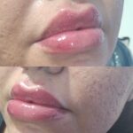 تزریق ژل با تکنیک M و بوتاکس مخصوص خانم ها و آقایان
