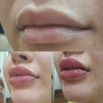 تزریق ژل با تکنیک M و بوتاکس مخصوص خانم ها و آقایان