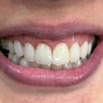دندانپزشکی زیبایی دکتر طاهریا/ جشنواره کامپوزیت