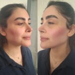 تزریق ژل با تکنیک M و بوتاکس مخصوص خانم ها و آقایان
