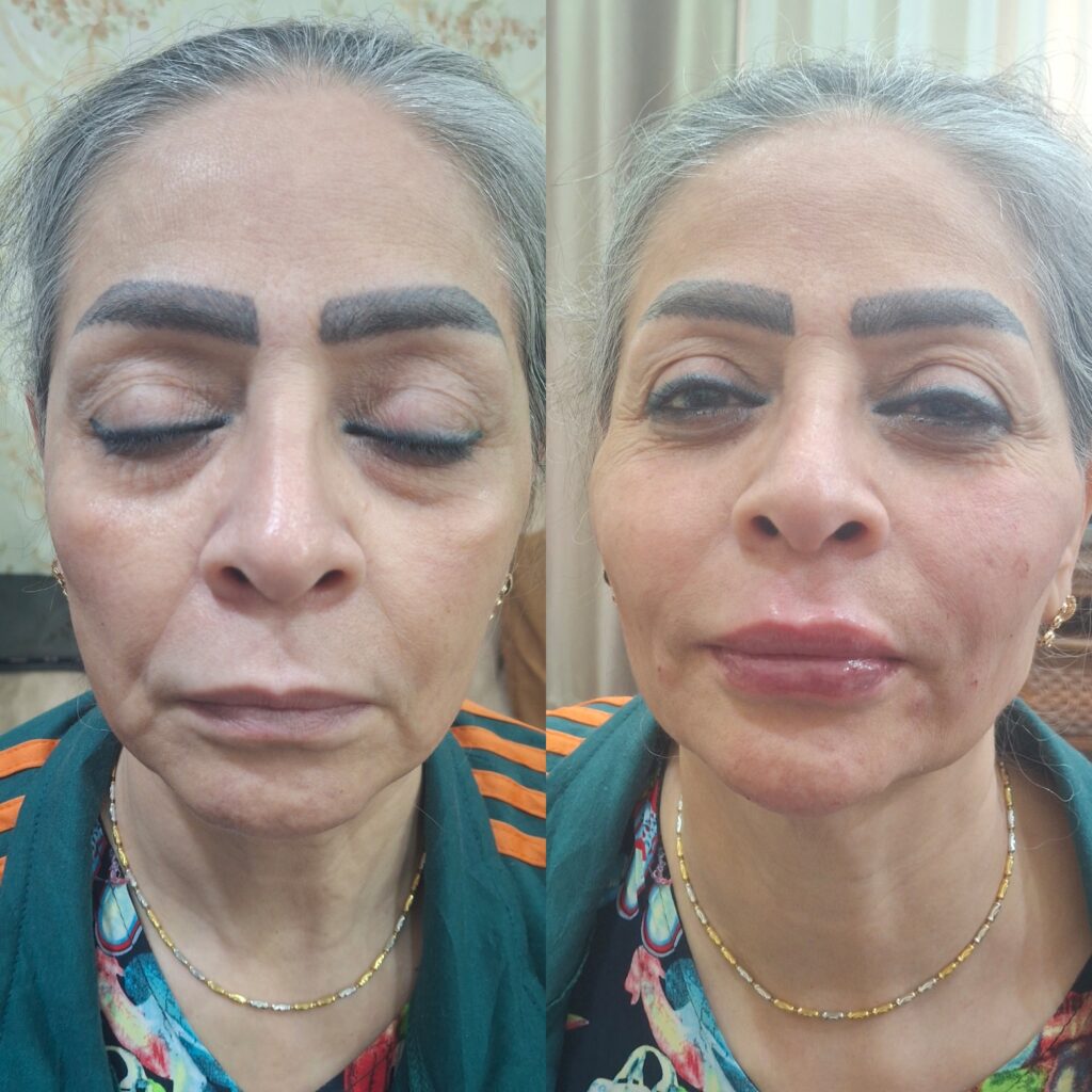 تزریق ژل با تکنیک M و بوتاکس مخصوص خانم ها و آقایان