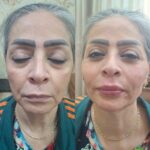 تزریق ژل با تکنیک M و بوتاکس مخصوص خانم ها و آقایان