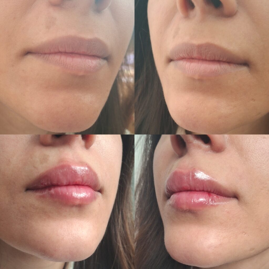 تزریق ژل با تکنیک M و بوتاکس مخصوص خانم ها و آقایان