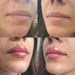 تزریق ژل با تکنیک M و بوتاکس مخصوص خانم ها و آقایان