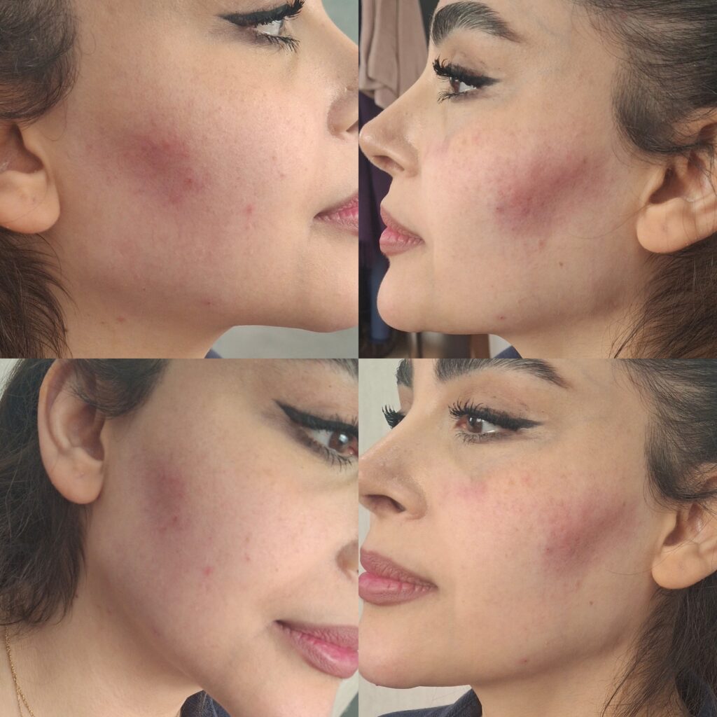 تزریق ژل با تکنیک M و بوتاکس مخصوص خانم ها و آقایان