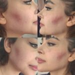 تزریق ژل با تکنیک M و بوتاکس مخصوص خانم ها و آقایان