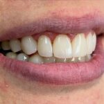 دندانپزشکی زیبایی دکتر طاهریا/ جشنواره کامپوزیت