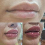 تزریق ژل با تکنیک M و بوتاکس مخصوص خانم ها و آقایان
