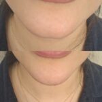 تزریق ژل با تکنیک M و بوتاکس مخصوص خانم ها و آقایان