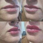 تزریق ژل با تکنیک M و بوتاکس مخصوص خانم ها و آقایان